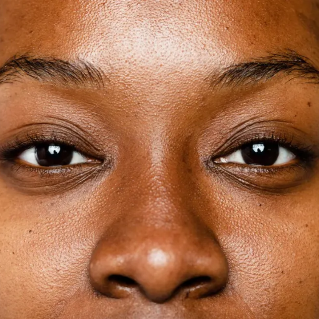 4 Acne Myths You Should Stop Believing