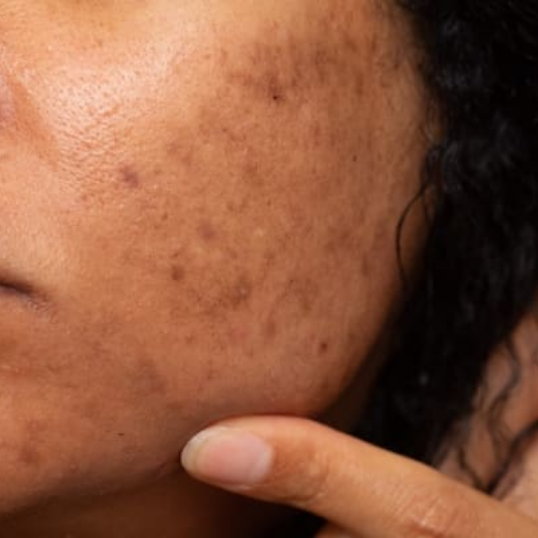 Fading the Spots: A Guide to Tackling Hyperpigmentation